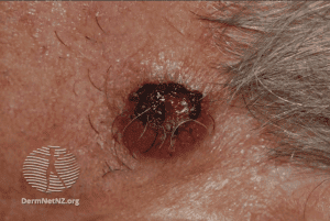Atypical fibroxanthoma (AFX)
