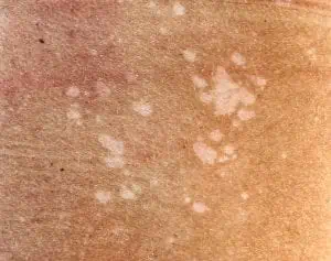 Close-up of tinea versicolor