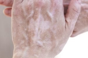 Vitiligo on a hand 