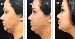 Before-and-after jowl treatment photos
