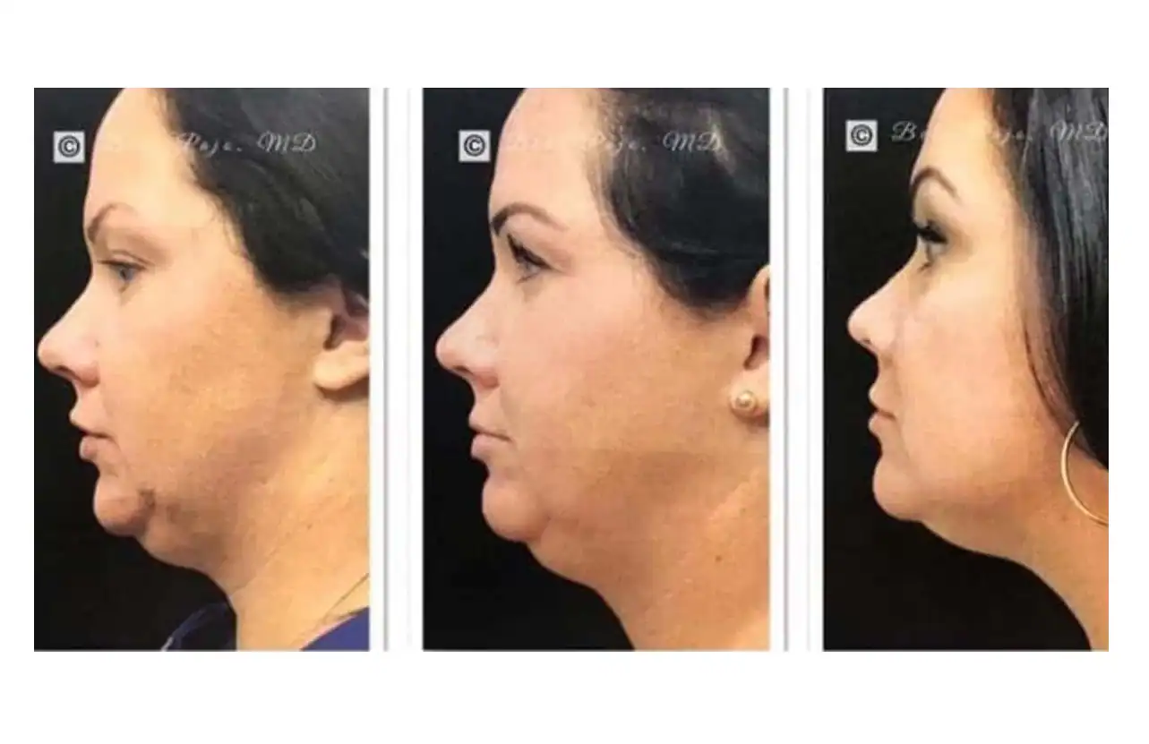 Female patient with jowls