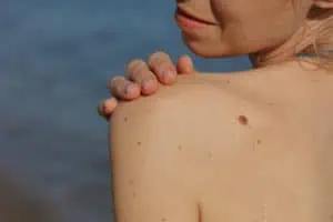 woman has a mole on her back