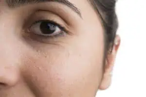 Closeup of milia on a woman’s face
