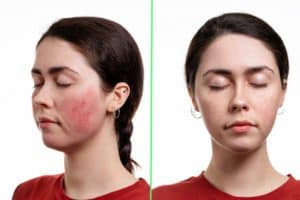 Two portraits of a young caucasian woman closed eyes with rosacea on her cheeks and without it
