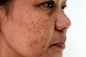 Woman with melasma