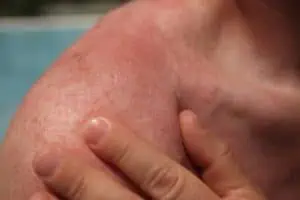 Summer skin rash