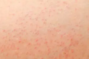 Hot tub folliculitis