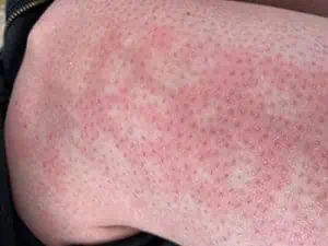 Plagued by a summer rash? How to tell if it's heat rash or something more  sinister