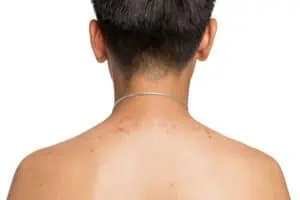 Male back acne