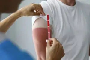 Man with severe sunburn on his arm