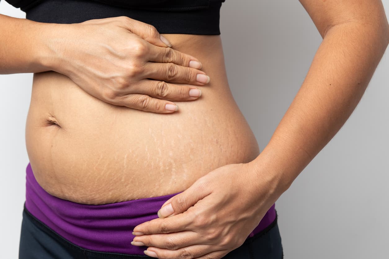 How to Get Rid of Stretch Marks Water's Edge Dermatology
