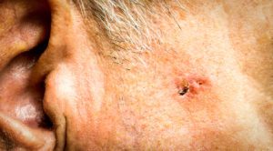 Man with basal cell carcinoma on face