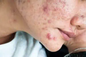 Woman with cystic acne