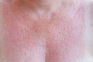 Sun rash on a woman’s chest from photosensitivity