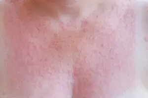 Sun rash on a woman’s chest from photosensitivity