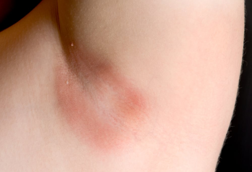 Cutaneous candidiasis: Symptoms and Treatment - Water's Edge