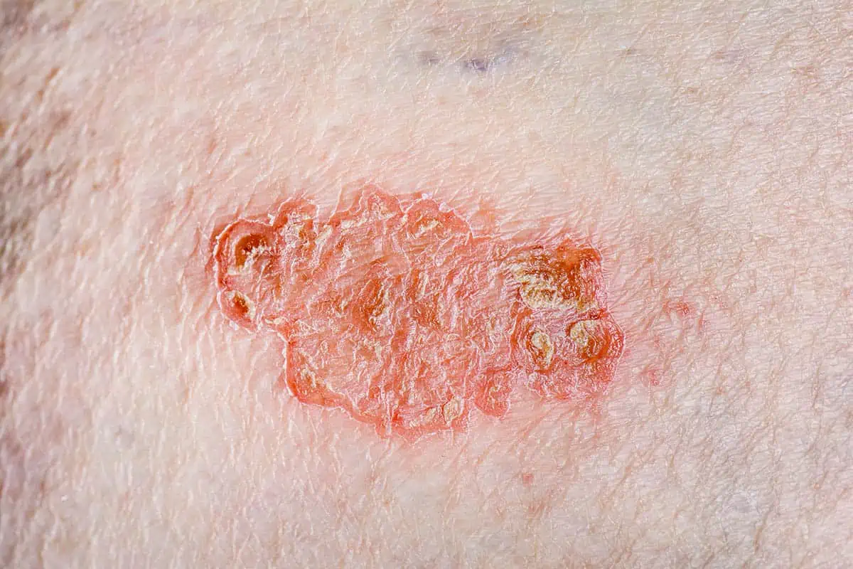 Closeup of a nummular eczema lesion