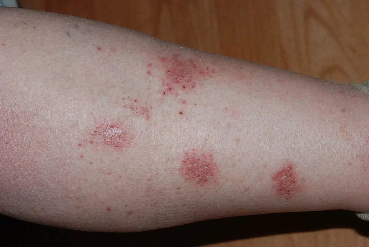 Nummular eczema on a leg