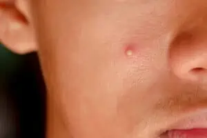 A young man with a pus-filled pimple who has avoided pimple popping.