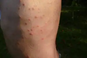 bed bug bites on a man's leg