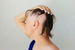 A woman with severe alopecia areata could potentially be helped by Litfulo, a new FDA-approved drug for hair loss.