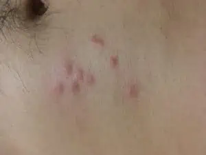 Bed bug bites on a man’s stomach