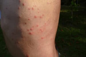 Bed bug bites on a man’s leg