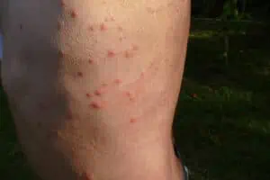 Bed bug bites on a man’s leg