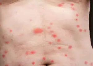 Large red bed bug bites on a man’s front