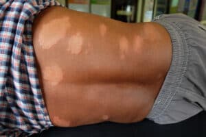 Large white patches on a man’s back are early leprosy symptoms 