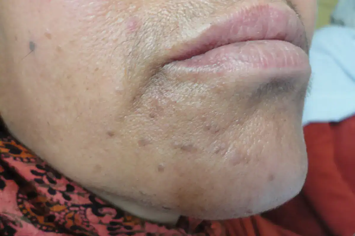 Verruca plana (flat warts) on the chin of a middle aged woman. Our Dermatology Online via Wikipedia Commons: https://www.odermatol.com/issue-in-html/2013-1-4-role/