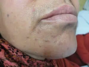Flat warts on the face of a woman