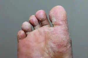 Ringworm on the foot, better known as athlete’s foot