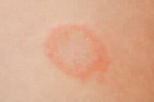 The characteristic red circle rash of ringworm