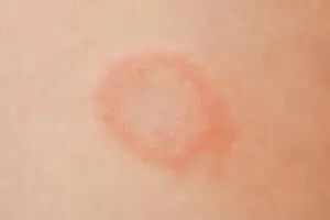 The characteristic red circle rash of ringworm