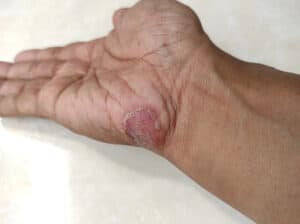 Ringworm on the hand 