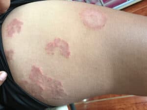 Ringworm rashes on a person’s leg
