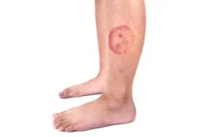 Ringworm rash on a man’s calf 