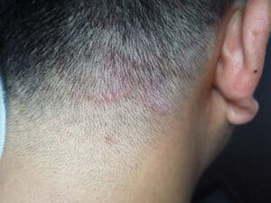 Scalp ringworm