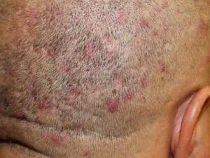 Malassezia folliculitis, or fungal acne, on a man’s scalp.