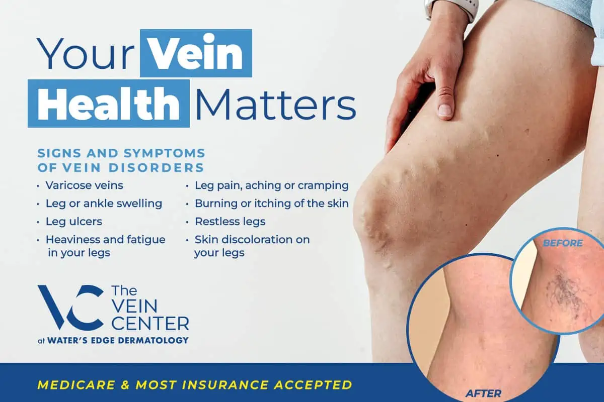 Veins Consultation Request