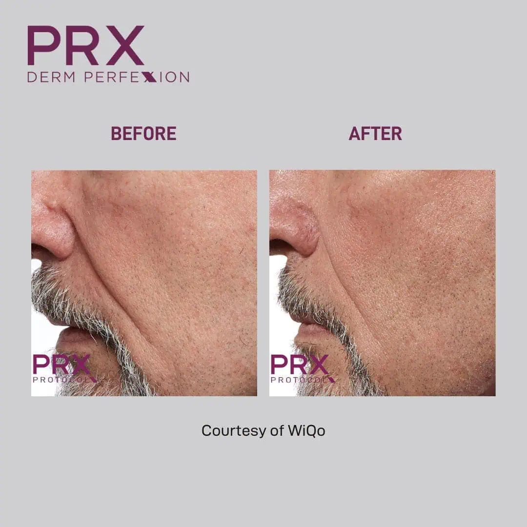 Before and After PRX Photo #3
