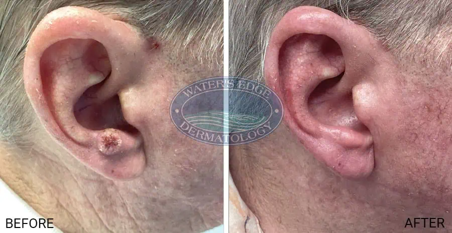 Before and After #1 - EBT