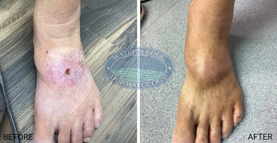 Before and After #2 - EBT