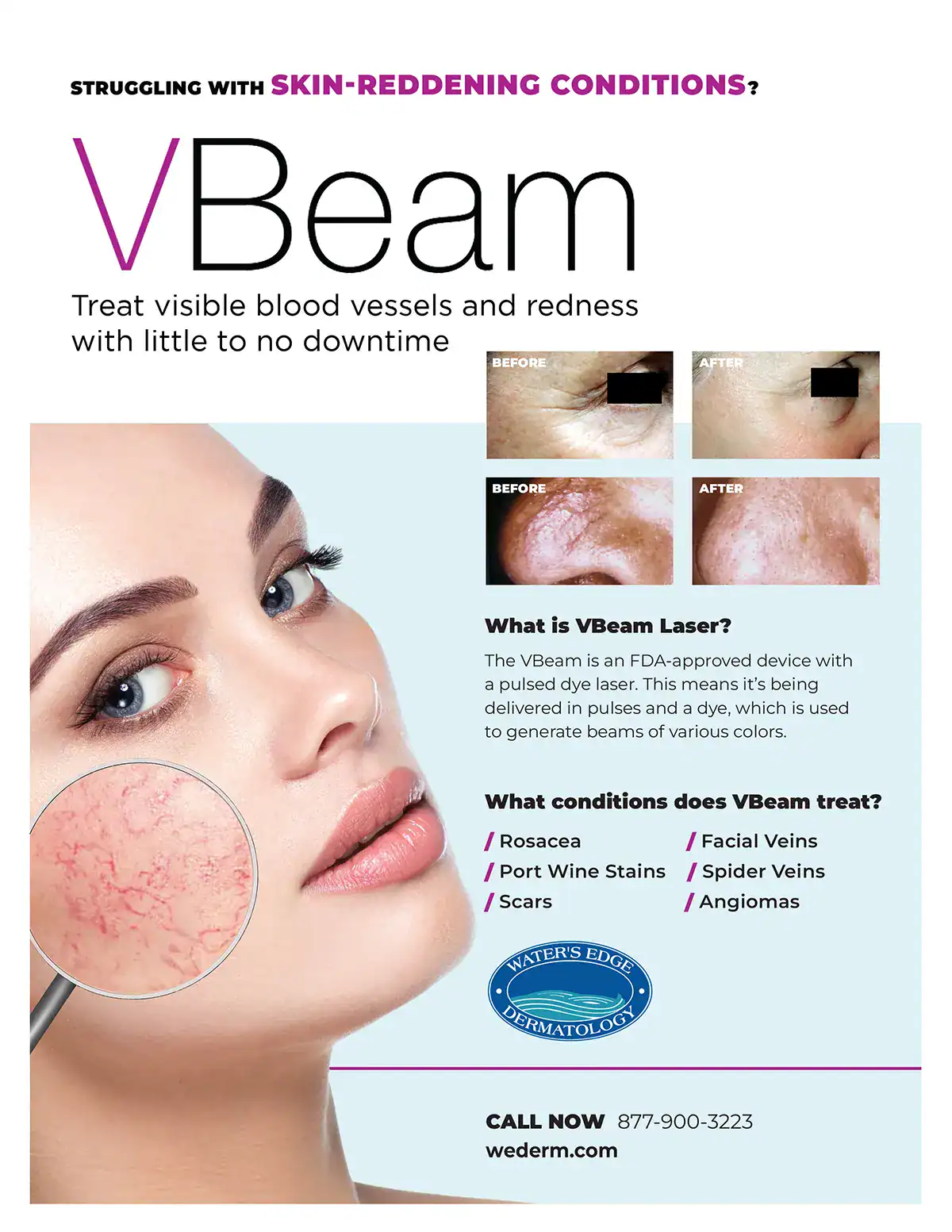Vbeam