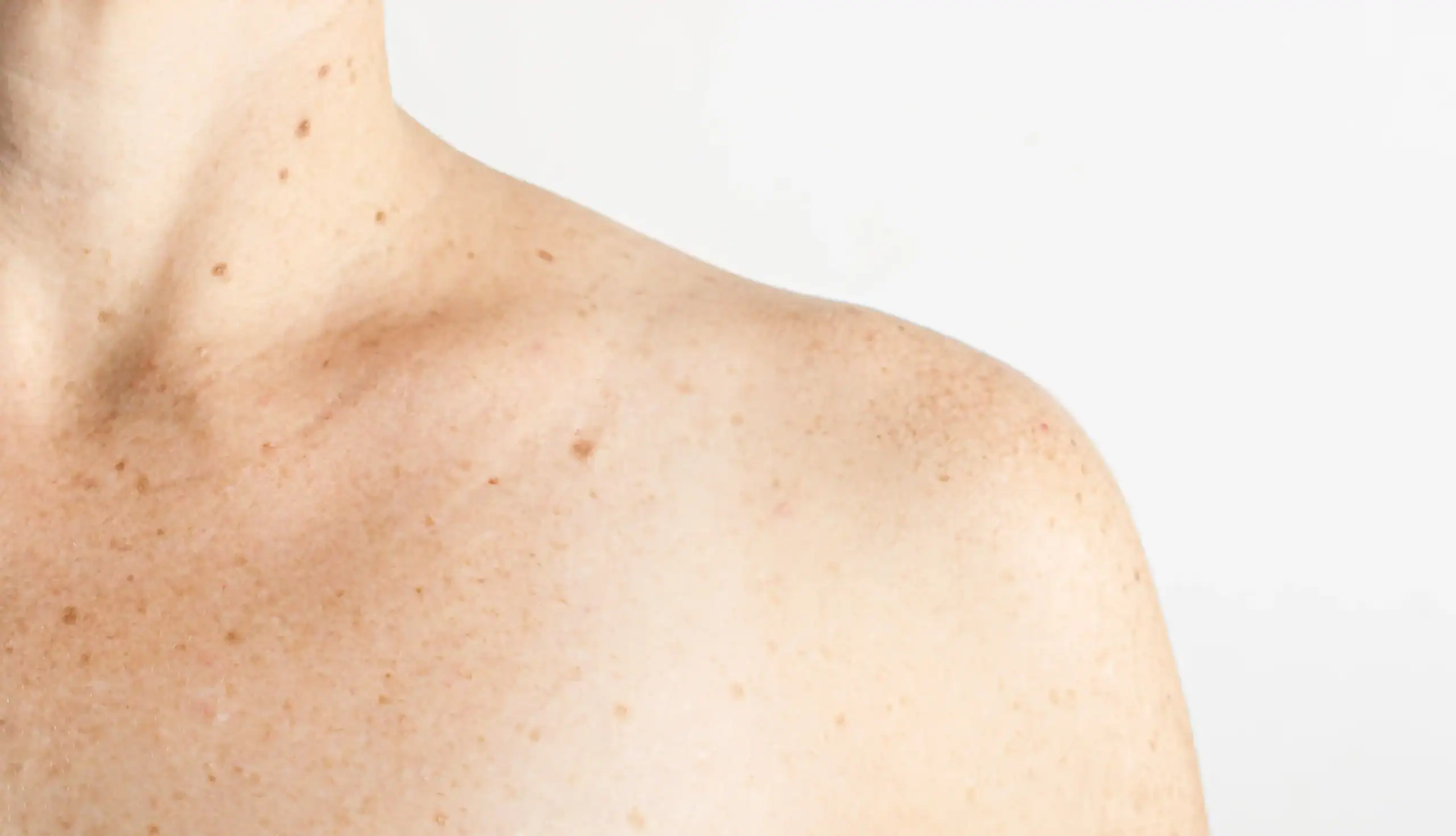 woman with pale skin and different types of moles and freckles