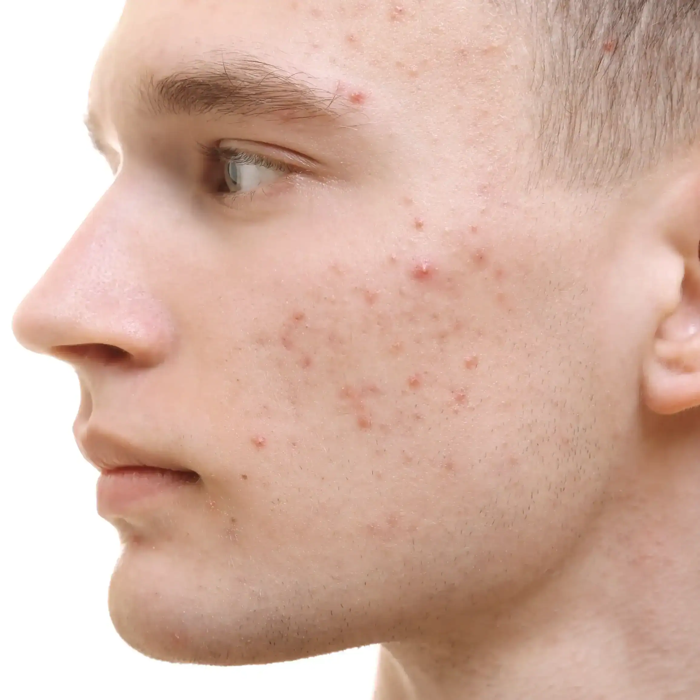 male teen with different types of acne