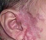 port-wine stain, type of birthmark