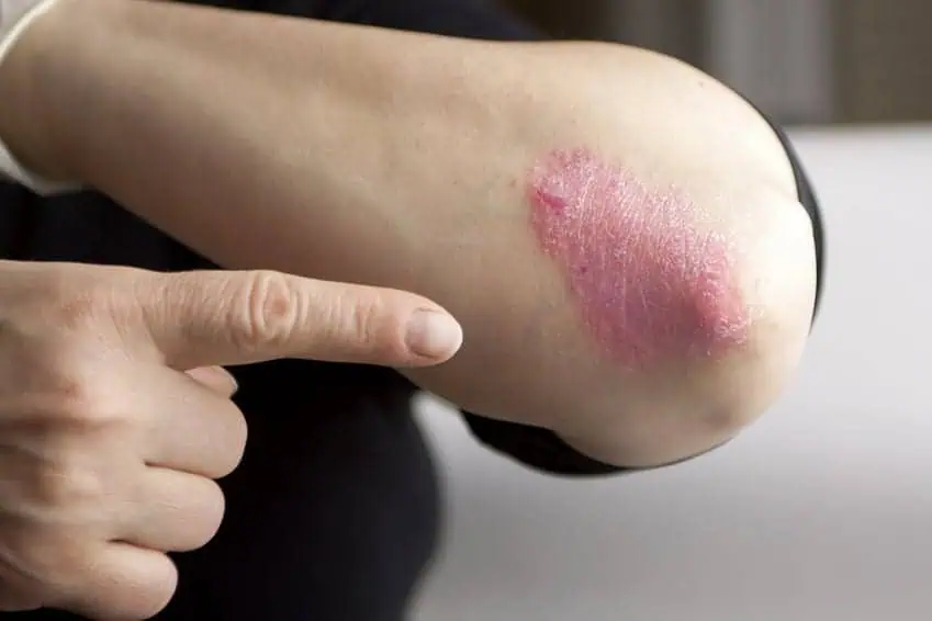 Skin condition on the elbow.