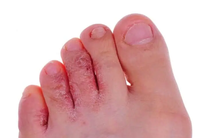 Athlete's Foot infection on toes